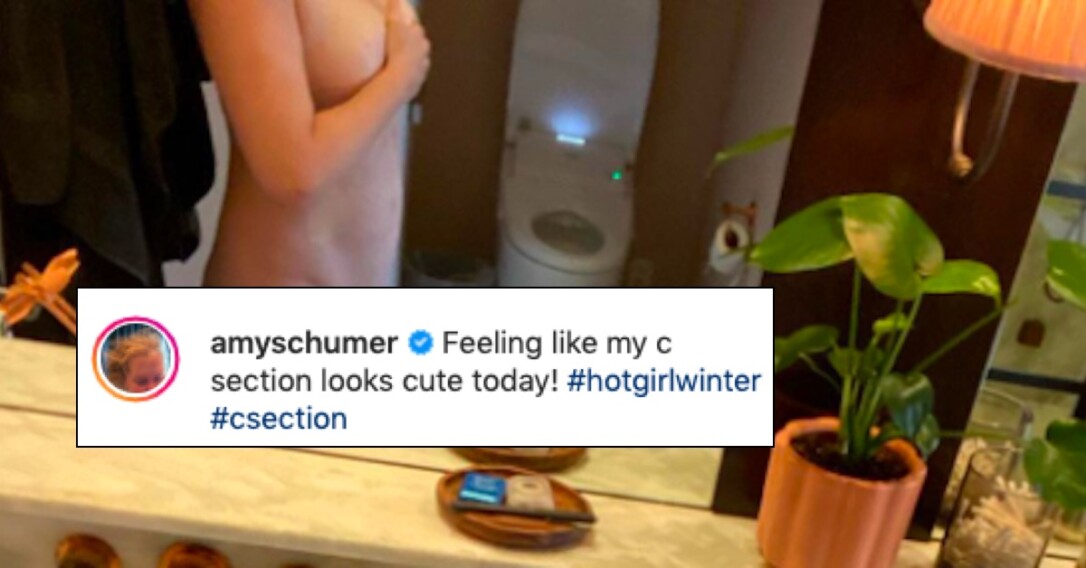 Amy Schumer Shares Explicit Photo Of Her C Section Scar