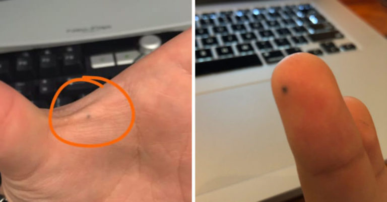 People Are Sharing Their Permanent Scars From Being ‘Poked With A Pencil’ Because We Were All Strange Children