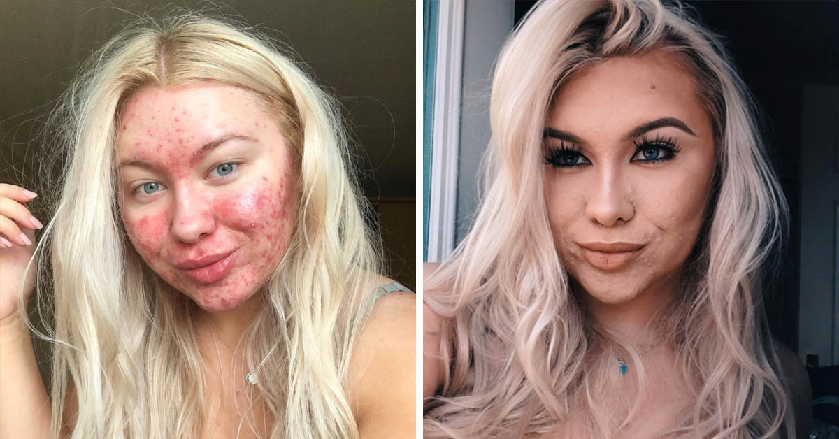 online dating acne