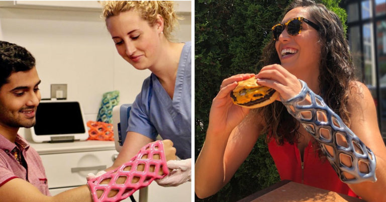 Engineering Students Create Waterproof Cast That Actually Lets You Scratch Itches