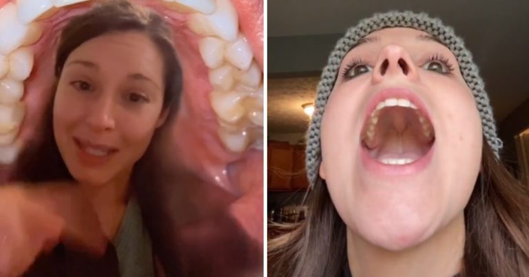 Apparently, Only 20-30% Of People Have A Hard Bump On The Roof Of Their Mouths