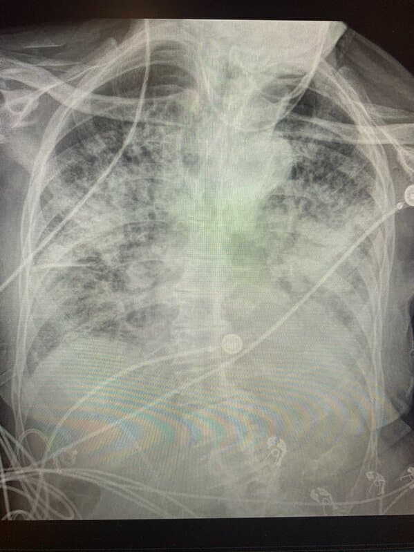Post covid lungs and smokers lungs, lung x-rays reveal post-covid lung, smoking vs covid x-rays, doctor on twitter tweets about covid, lungs, news
