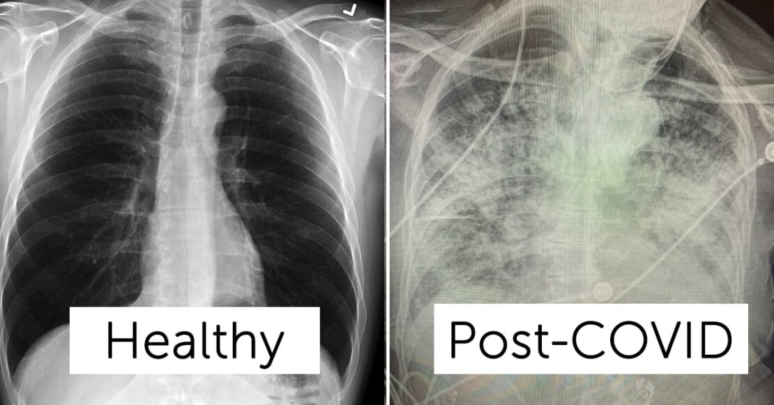 X-Rays Of COVID Patient Lungs Reveal How Much Worse COVID Is Than Smoking