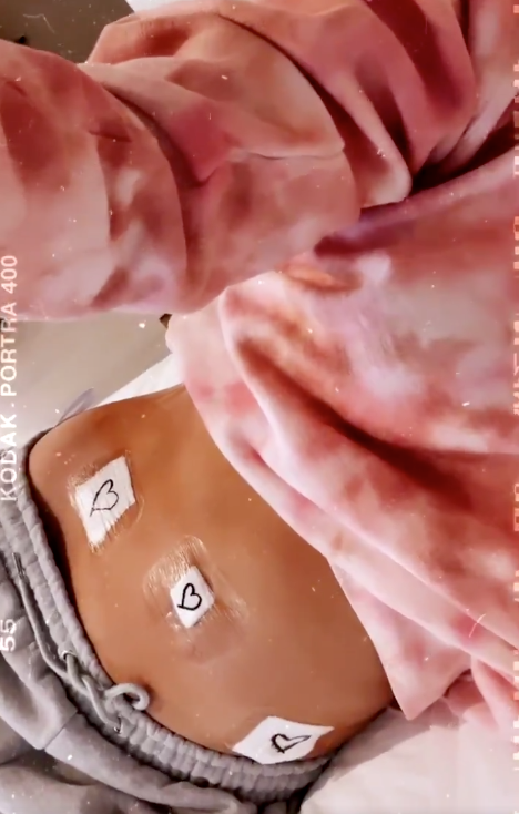 chrissy teigen Endometriosis Scars