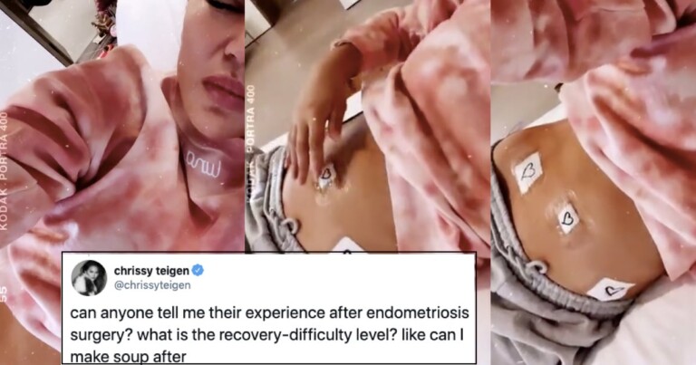 Chrissy Teigen Reveals Endometriosis Scars For Valentine’s Day