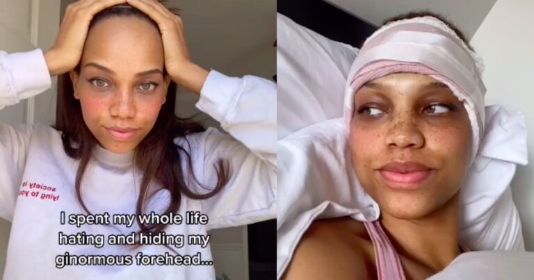 forehead surgery, forehead reduction surgery