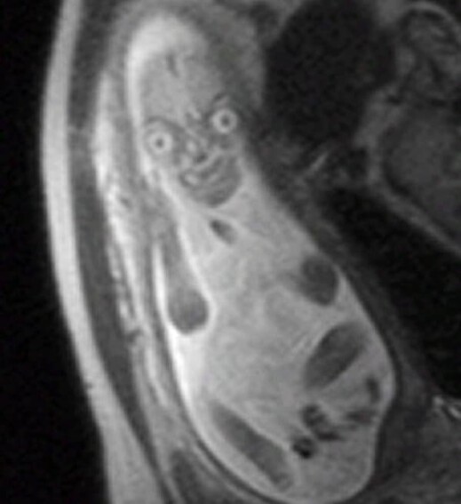 pregnant xray