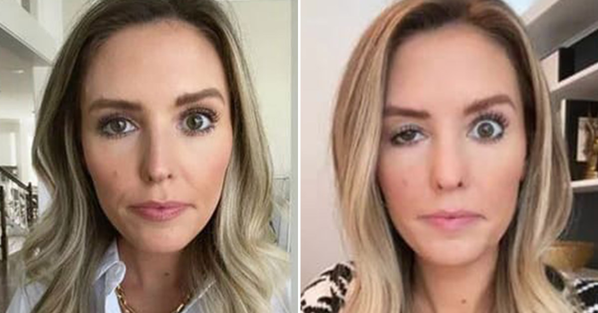 People In The Botched Surgeries Reddit Share Pictures Of Their Horrible Plastic Surgery Fails