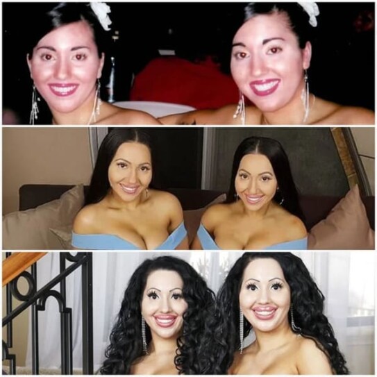 People In The &quot;Botched Surgeries&quot; Reddit Share Pictures Of