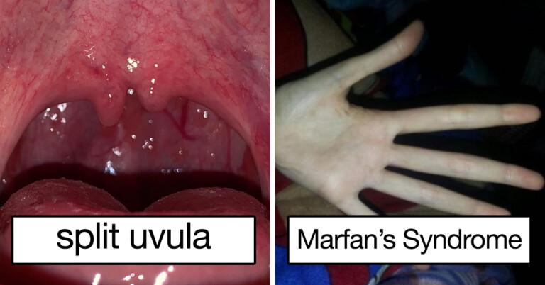 People Share Strange, Interesting Body Abnormalities (19 Pics)
