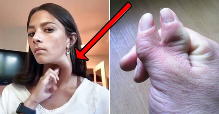 50 Photos Of People Showing Off Their Unique Genetic Traits